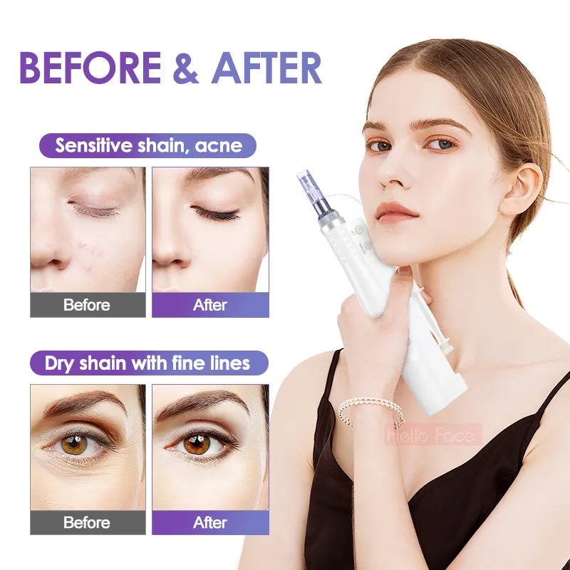 Hello Face 2 in 1 Portable Water Light Injection Aqua Derma Pen With 12 Pin Needle